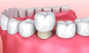 Dental Crowns