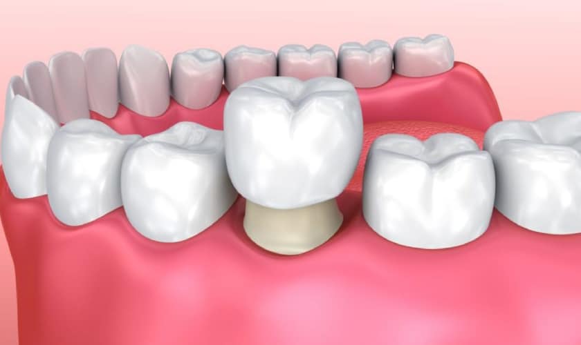Dental Crowns