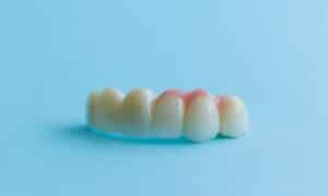 dental bridges-watford dental