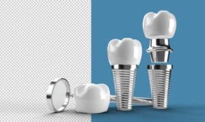 Dental Implants In Watford Dental Office Watford Ontario Canada
