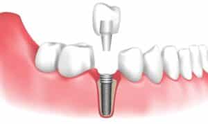 Dental Implants in Watford ON