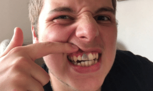 My Tooth Is Turning Dark (Black): What Should I Do?