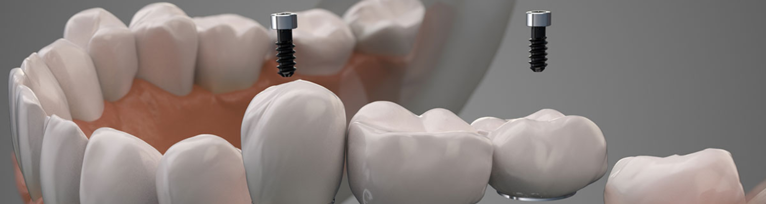 dental implants in watford