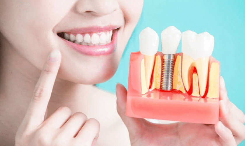 The Complete Guide to Dental Implants Everything You Need to Know