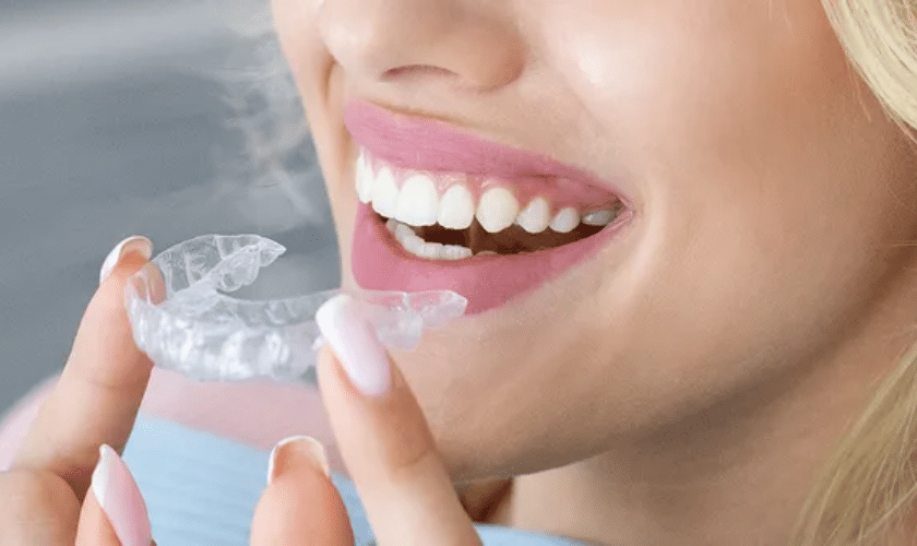 The Step-by-Step Process of Getting Invisalign