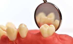 how to fix gap between crown and gum