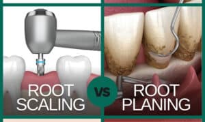 what is the difference between root scaling and root planning