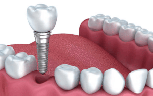 Link between Dental Implants and health