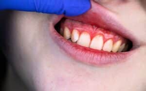 periodontal care for pregnancy gum disease