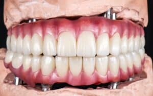 What Happens If a Dental Implant Fails Next Steps