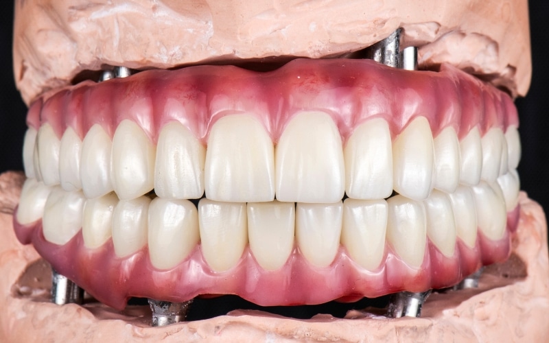 What Happens If a Dental Implant Fails Next Steps