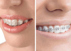 Clear Braces Vs Aligners