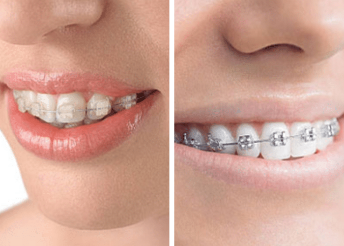 Clear Braces Vs Aligners